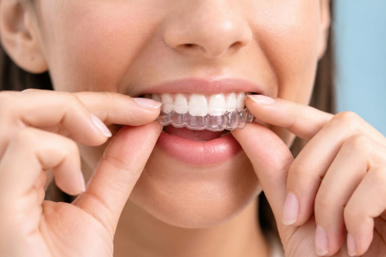 A patient placing a clear orthodontic aligner over their upper teeth