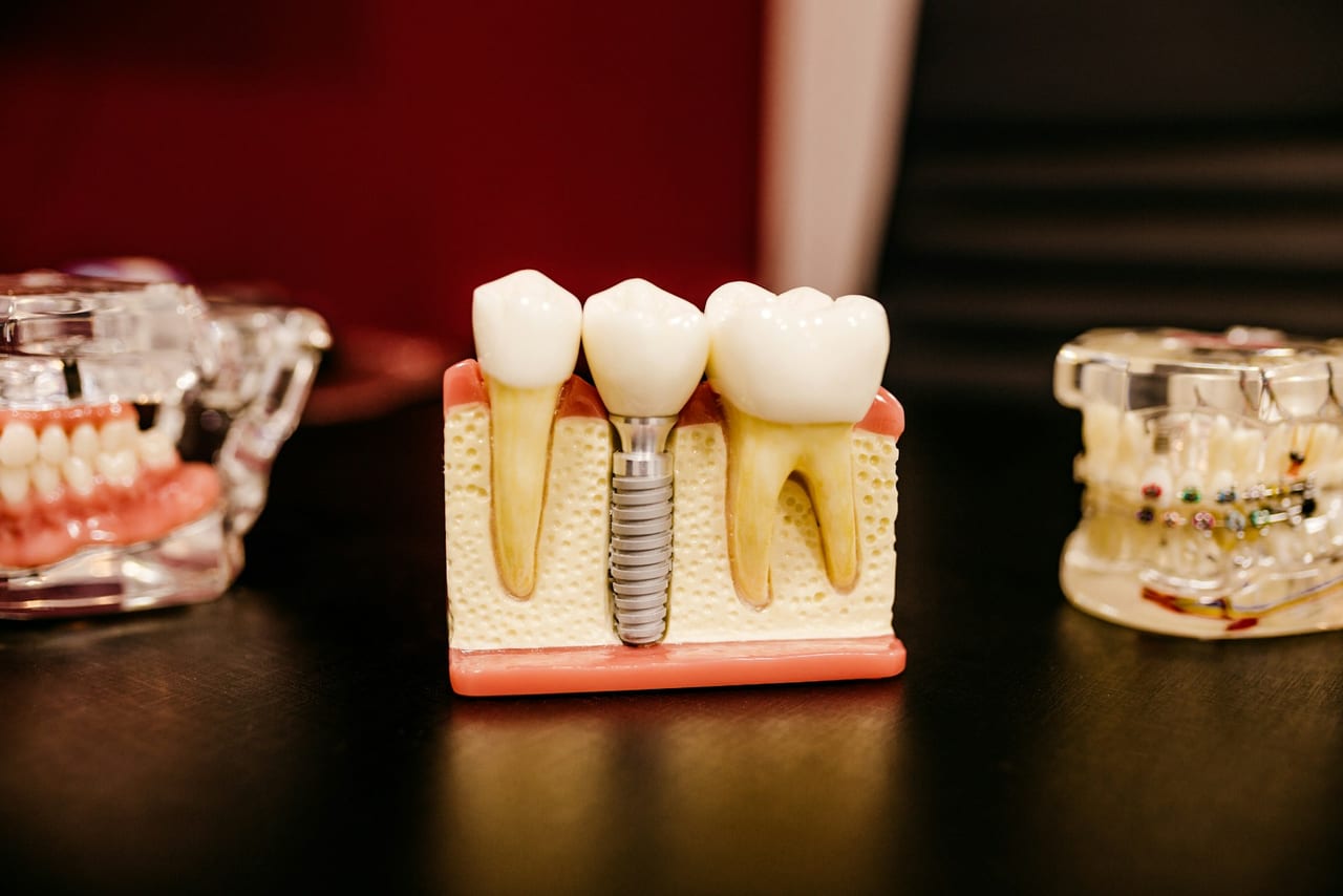 A dental model showing how an implant sits in the jawbone beneath a replacement crown