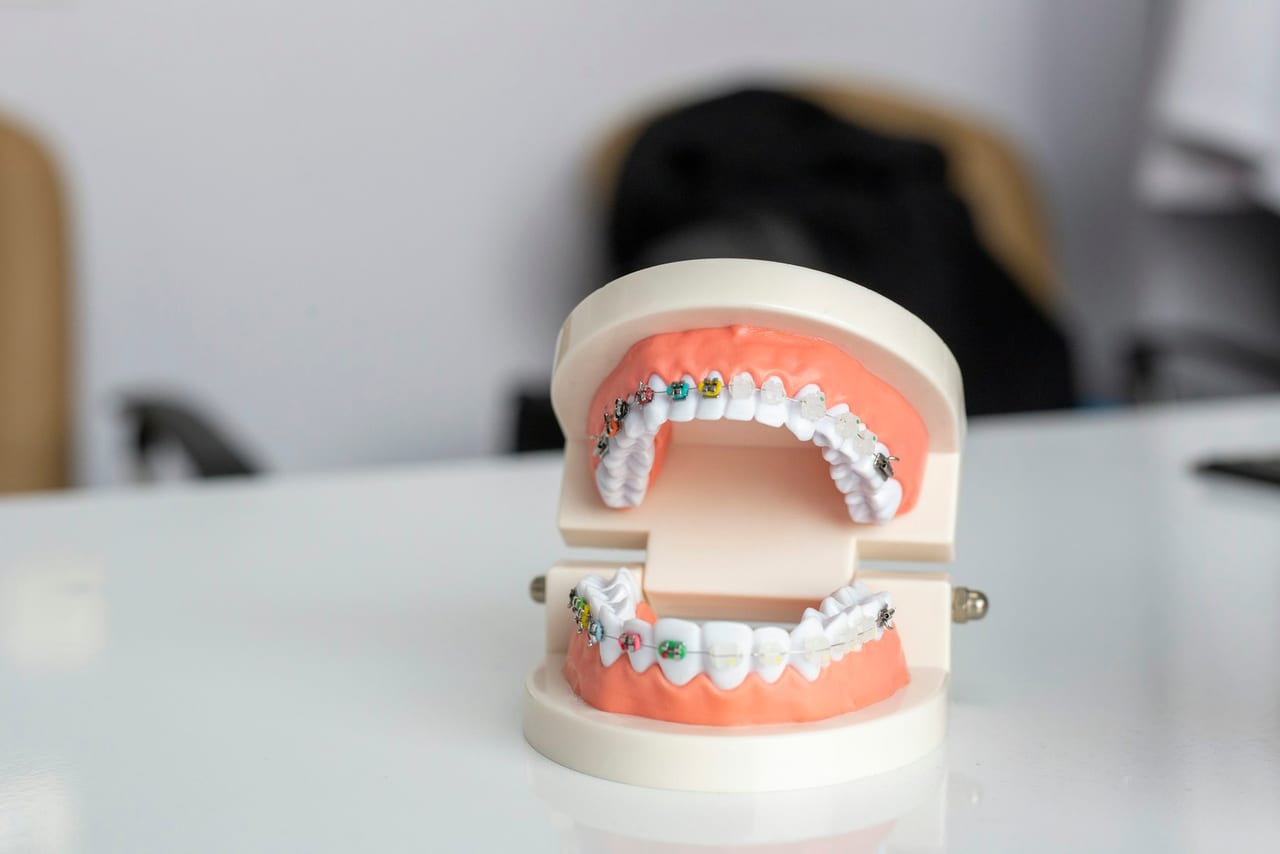 An orthodontic study model of the upper and lower teeth fitted with braces