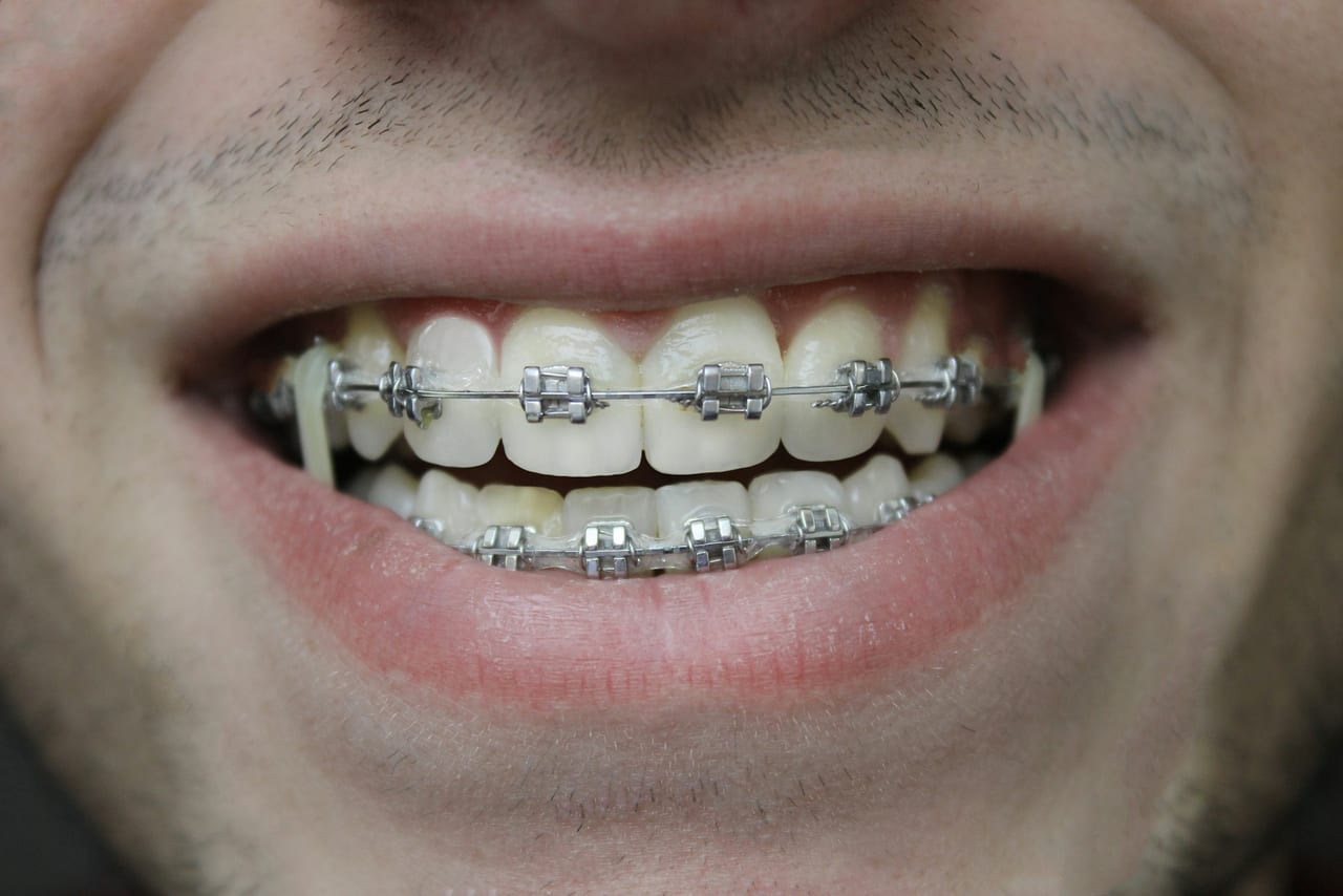 A close-up of fixed orthodontic braces on a patient's upper teeth